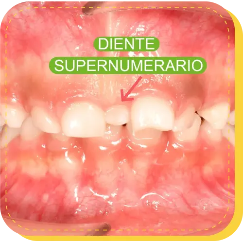 tratamiento diente supernumerario surco lima