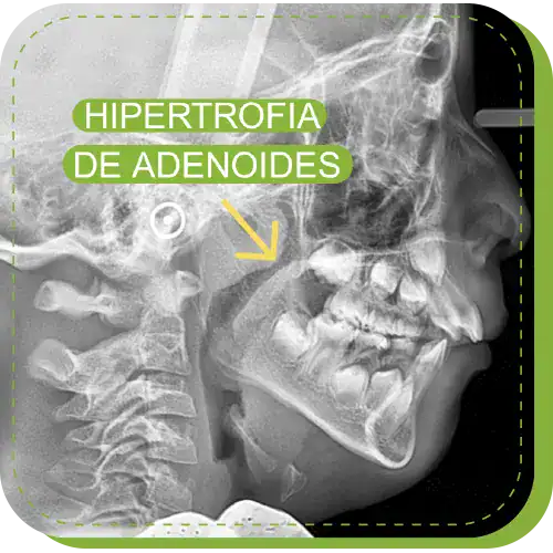 tratamiento hipertrofia de adenoides lima