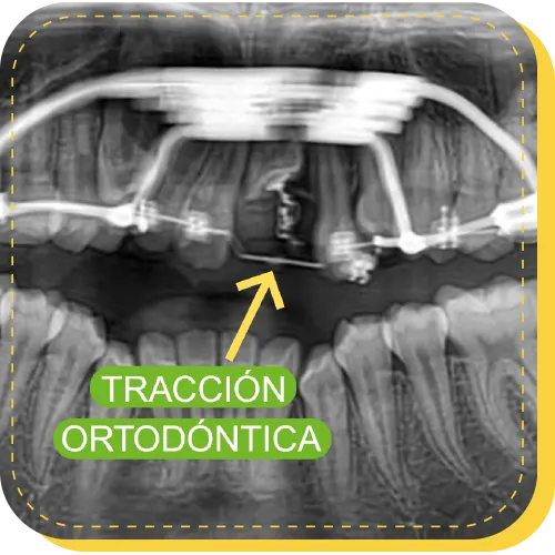 tratamiento operacion traccion ortodontica surco lima