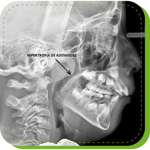 tratamiento para habitos que afectan sueño surco lima