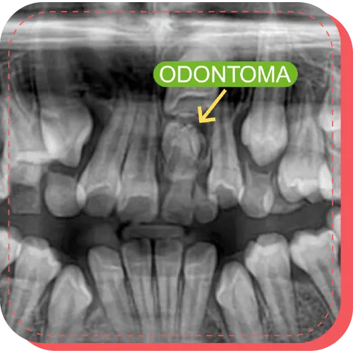 tratamiento retiro odontoma surco lina