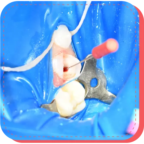 tratamientos pulpares surco lima