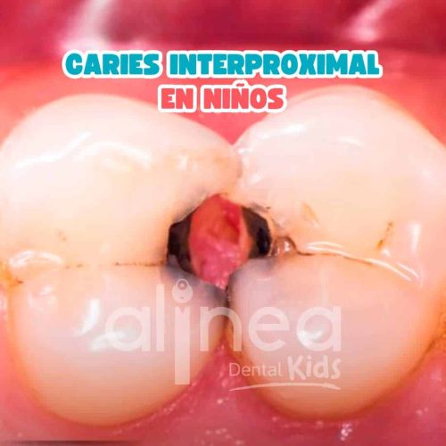 CARIES-INTERPROXIMAL-EN-NIÑOS-