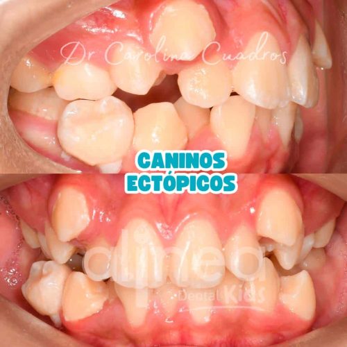 Caninos Ectópicos-