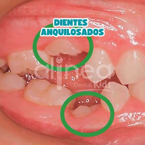 DIENTES ANQUILOSADOS