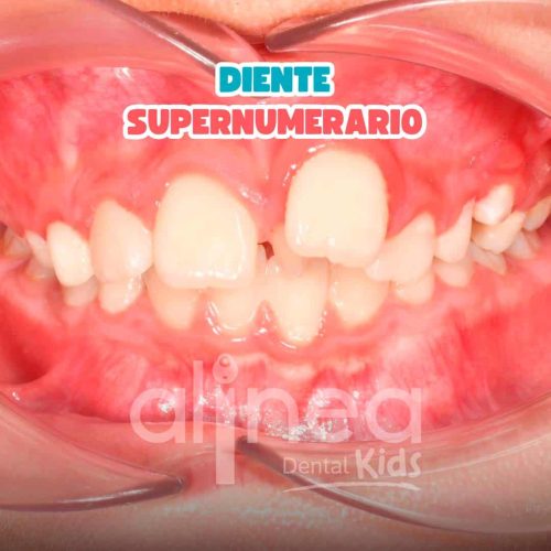 DIENTES SUPERNUMERARIOS
