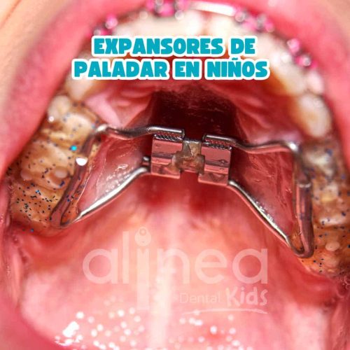 Expansores de Paladar en Niños
