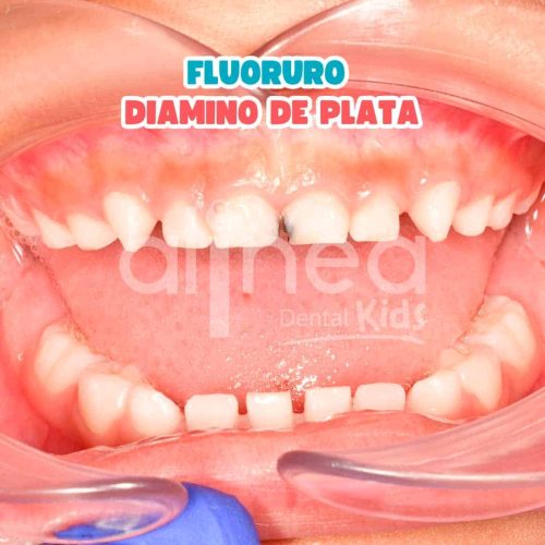 FLUORURO
