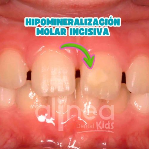 HIPOMINERALIZACIÓN