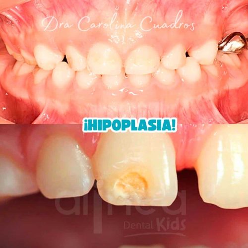 Hipoplasia
