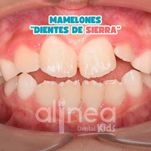 MAMELONES “DIENTES DE SIERRA“