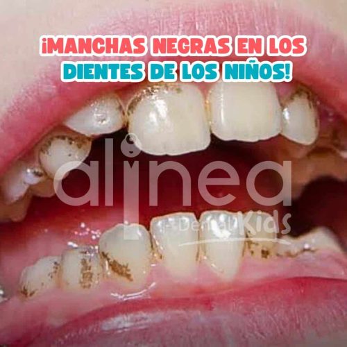 MANCHAS NEGRAS EN DIENTES_
