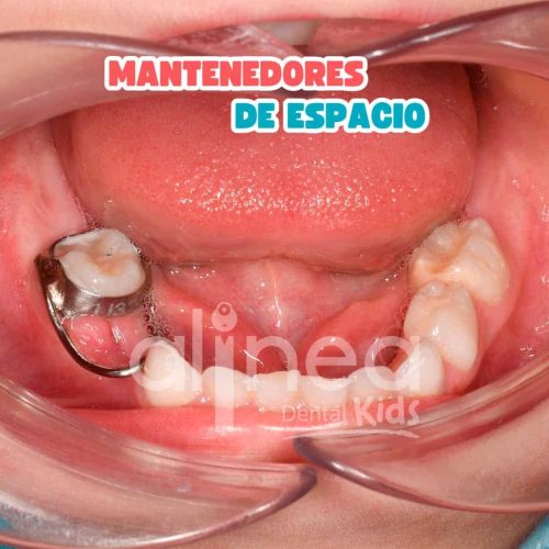 MANTENEDORES DE ESPACIO_
