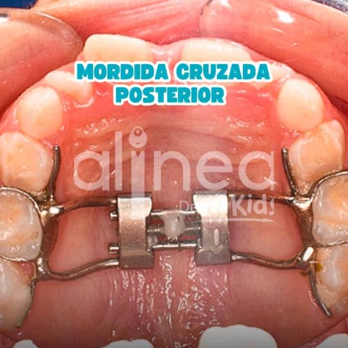 MORDIDA CRUZASA POSTERIOR_