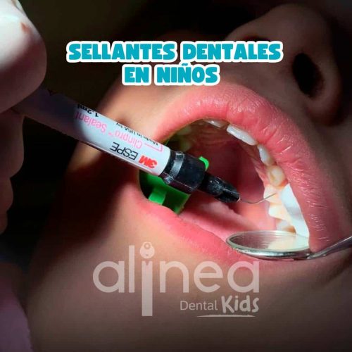 SELLANTES DENTALES EN NIÑOS_