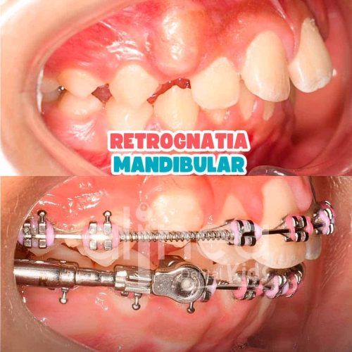 retrognatia mandibular